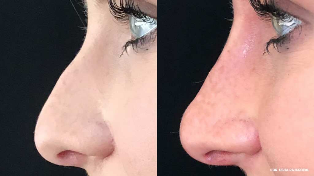 Nonsurgical rhinoplasty is a procedure also called liquid rhinoplasty or lunchtime rhinoplasty (other nicknames available too).