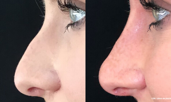 Nonsurgical rhinoplasty is a procedure also called liquid rhinoplasty or lunchtime rhinoplasty (other nicknames available too).
