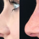 Nonsurgical rhinoplasty is a procedure also called liquid rhinoplasty or lunchtime rhinoplasty (other nicknames available too).